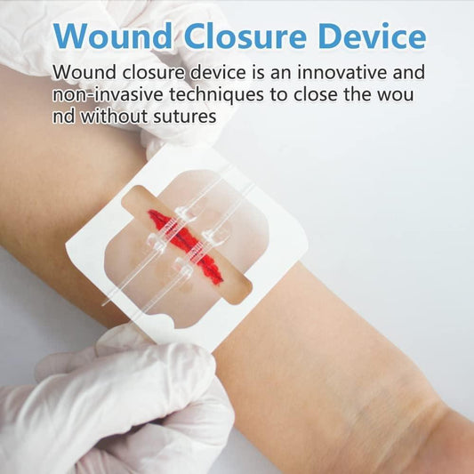 Wound Closure Device - Peppeuk Ltd